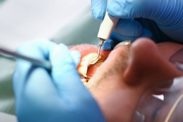 Best Emergency Dentist for Lost Fillings or Crowns in Ridgeland, MS